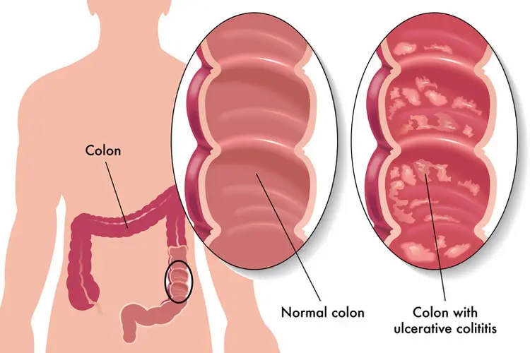 Treatment for Colitis